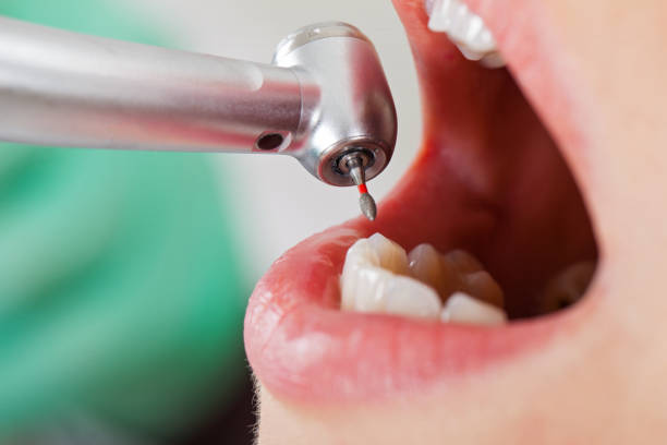 Best Emergency Tooth Extraction in Rio Communities, NM